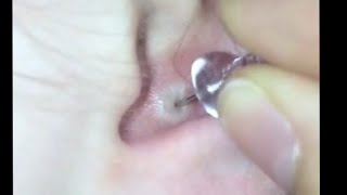 💥💥BLACKHEAD REMOVAL IN THE EAR this is not hygienic can get an infection must be carefull [upl. by Ansell]