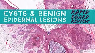 Rapid Board Review Cysts amp Benign Epidermal Lesions Dermpath Dermatology Pathology [upl. by Atisor]