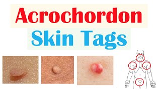 Skin Tags Acrochordons  Causes Risk Factors Symptoms Diagnosis Treatment [upl. by Standley741]