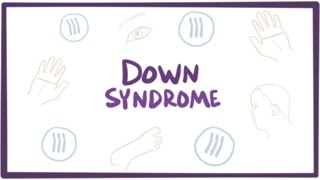 Down syndrome trisomy 21  causes symptoms diagnosis amp pathology [upl. by Ira]