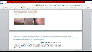 Plab 1 Lectures Dermatology Part 4 Guttate PsoriasisUrticaria [upl. by Torey]