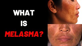 WHAT IS MELASMA CausesSymptomsDefinitionTreatmentCreamRemovalTipsChloasmaFoodsVitamins [upl. by Athallia598]