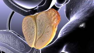 Prostate Cancer Animation [upl. by Orestes]