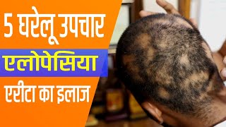 5 Home Remedies for Alopecia Areata Treatment of Alopecia Areata [upl. by Airdnaid890]