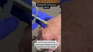 Actinic Keratosisprecancerous spot removal dermatology skin skincancer skincancerprevention [upl. by Sloan366]