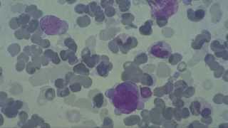 Hematology Bone Marrow Hemoblastosis [upl. by Axe695]