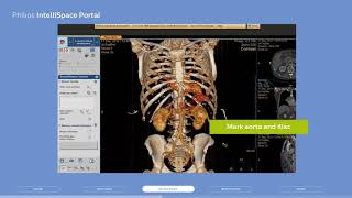 Philips IntelliSpace Portal clinical application CT TAVI planning [upl. by Asena]