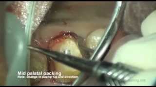 Gingival Retraction methods [upl. by Harihs]