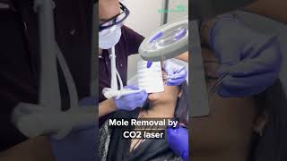 Mole Removal by CO2 Laser [upl. by Francis633]