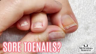 Sore Toenails Is it Impacted or Ingrown [upl. by Jobi]