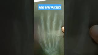 Hand bone fracture [upl. by Tamer]