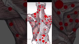 Trigger point therapy  Saara physio [upl. by Rafaello]