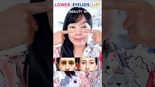 LOWER EYELIDS LIFT  Increase Fat Under eyes Fix hollow eyes and tear trough [upl. by Katuscha17]