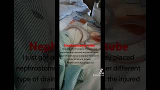 Nephrostomy tube placement kidneyrecipient kidneywarrior urineleak transplantwoes transplant [upl. by Bolten392]