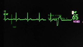 sinus rhythm with ventricular extrasystoles on an ECG monitor [upl. by Sandeep]