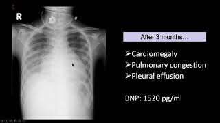 Ebstein anomaly complicated with acute tachyarrhythmia and right heart failure [upl. by Magnusson]