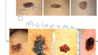 Nevi vs Melanoma [upl. by Mina572]