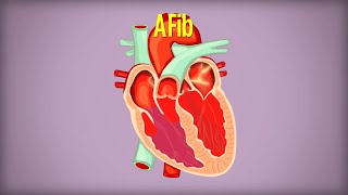 Living with Atrial Fibrillation AFib [upl. by Dawna908]