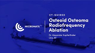 Micromate™  CTguided RoboticAssisted Osteoid Osteoma Radiofrequency Ablation [upl. by Mallin]