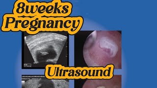 8 weeks Pregnancy  Early Pregnancy  Alive Fetus  Anomaly Scan  Normal Obs Ultrasound [upl. by Radbourne]