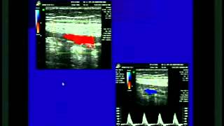 ECOGRAFIA DOPPLER ARTERIAL PERIFERICO [upl. by Tehc423]