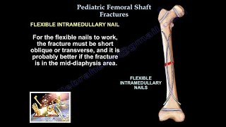 Pediatric Femoral Shaft Fractures  Everything You Need To Know  Dr Nabil Ebraheim [upl. by Sidnarb]