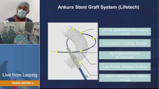 LINC 2017 Lifetech Ankura TEVAR live case with Dr Andrej Schmidt [upl. by Giustino474]