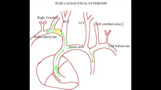 Discuss subclavian steal syndrome adding its neurological symptoms [upl. by Savill]