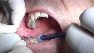 Third molars extraction without pliers and bleeding with piezosurgery in HD [upl. by Ecinahc]