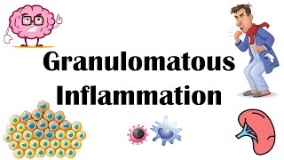 Granulomatous Inflammation  Types Pathophysiology Different Cell Types In Granuloma amp Examples [upl. by O'Donovan590]