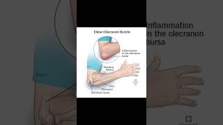 Elbow bursitisexcercisethephysiodoctoranatomyphysiotharapisthumananatomysportselbowpain [upl. by Hakim]