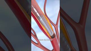 What is the Angioplasty Procedure [upl. by Anaerda288]