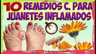 COMO ELIMINAR LOS JUANETES con Estos 10 Remedios Caseros Para los JUANETES INFLAMADOS [upl. by Rakia939]