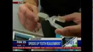 CES Acceledent News Fox 25 Boston [upl. by Rab]