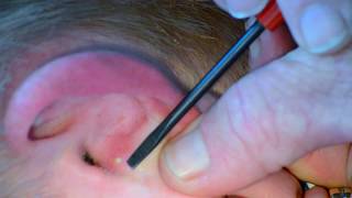 Painful Ear Pimple Popped and Slowly Pressured [upl. by Maegan]