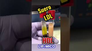 Riesgo Cardíaco Suero Lipemico bioanálisis infarto corazon laboratorio udo biología [upl. by Asirram]