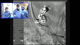 Celiac Artery Aneurysm Embolization using a Transradial Approach [upl. by Sirdna]