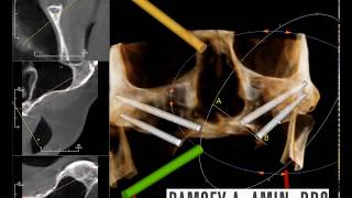 Zygomatic Implant Planning Ramsey Amin DDS Burbank [upl. by Ayhdnas]