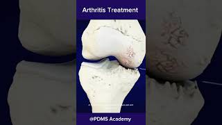 How to treat Arthritis best treatment for rheumatoid arthritis medicine [upl. by Akinna49]