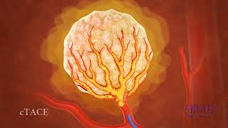 Liver Tumor Embolization amp Chemoembolization [upl. by Lombardy]