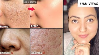 कितने भी पुराने OPEN PORES LARGE PORES CLOGGED PORES हों इस Remedy से होगा 100 इलाज़ [upl. by Aihtyc112]