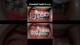 40 months for this braces Crowded teeth braces orthodontist dentist dentistry [upl. by Iain]