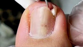 Dig out ingrown toenails at the root  remove dead skin！【Foot scalpel】 [upl. by Eilzel263]