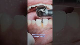 Cavities between front teeth viral smile fashion veneers youtubeshorts composite bondingasmr [upl. by Reffotsirk538]