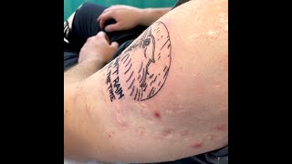 TATTOOS OVER SEVERE ACNE SCARS LETS FIND OUT [upl. by Ahsitahs871]