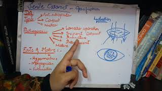 SENILE CATARACT very IMPORTANT topic ade simple part 1 [upl. by Nerred]