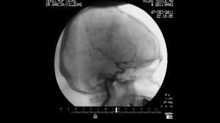 Panangiografía Cerebral Diagnóstica [upl. by Mita111]