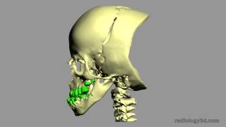 Malposizione Dentale Tooth Malposition [upl. by Anahahs5]