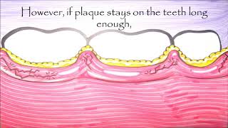 The Long Term Effects of Plaque and Bacteria Staying Under the Gums [upl. by Inaej]