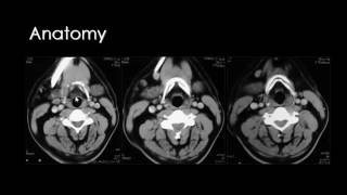 Imaging of Larynx Dr Mamdouh Mahfouz [upl. by Parette]